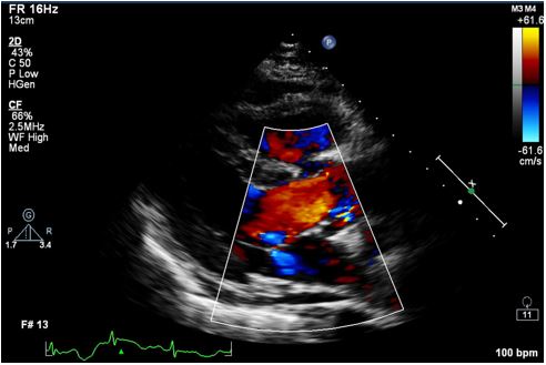 Vascular Ultrasound